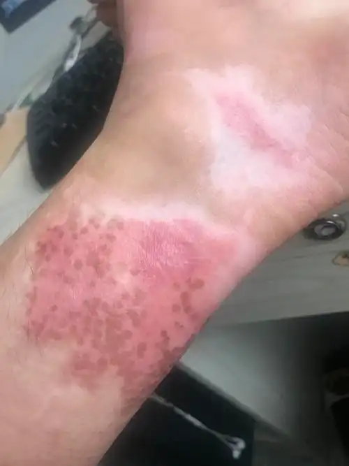 深二度烫伤恢复的心路历程大神帮忙看下会不会留疤