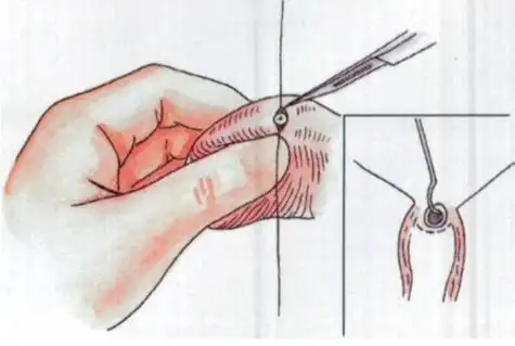 男性结扎的好处和坏处,在这里一一列举