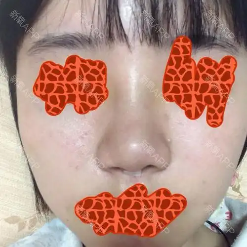 鼻孔不对称这样是失败了吗[:9][:9]_圈子-新氧美容整形