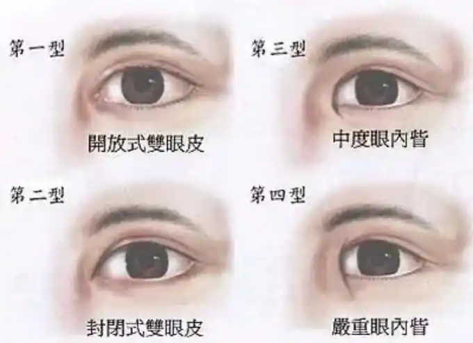 通常我们说的开眼角都是开内眼角,就是切除内眦赘皮的手术,一般适用于