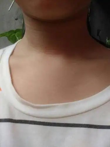 为什么锁骨中间凸起?