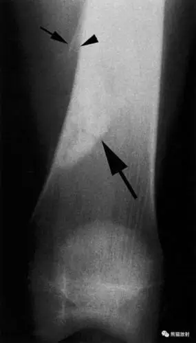 骨膜:侵袭性骨膜炎丨鉴别诊断