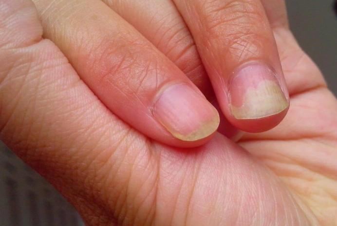 贫血指甲图片 (46)
