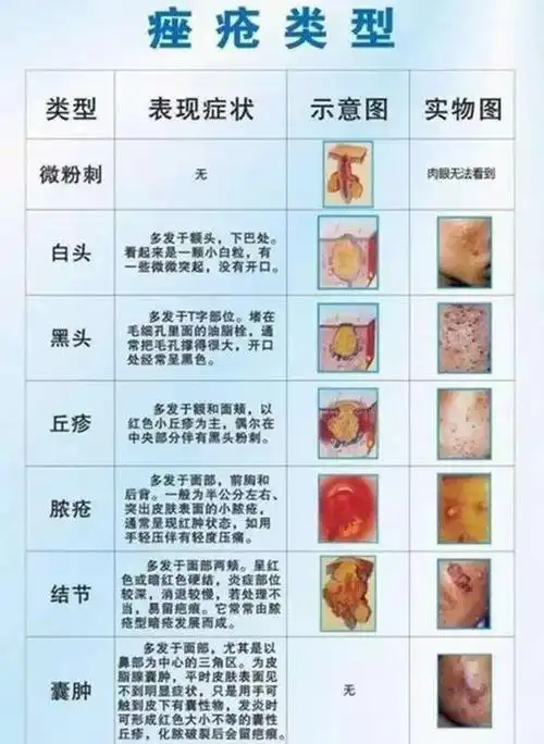 如何正确处理痘痘?