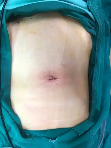 单孔腹腔镜胆囊切除术