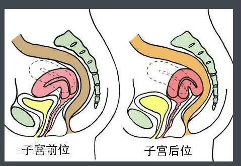 女性子宫前位会压迫到膀胱引起尿频吗