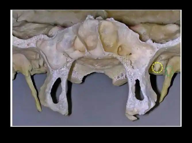 前面观.蝶骨棘(红色虚线圈),位于鞘突(绿色虚线圈)的内侧.图14.