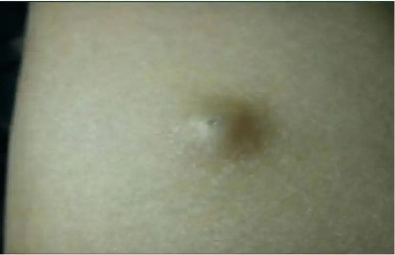 来源于皮脂腺阻塞所致,好发于头部,中央处可见黑色毛囊孔,破溃后流出