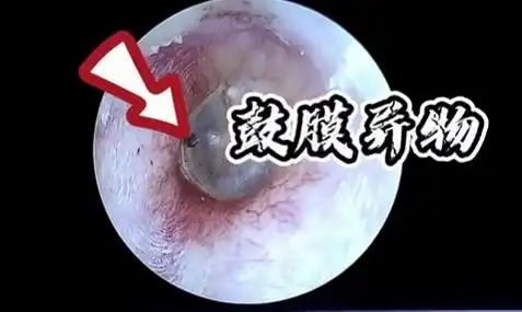 当耳道被放大数倍,你可以直观地看到挖耳朵造成的伤害