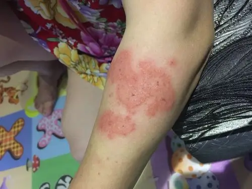 妈妈夏天晒后就起这样的水泡,求助各位了!