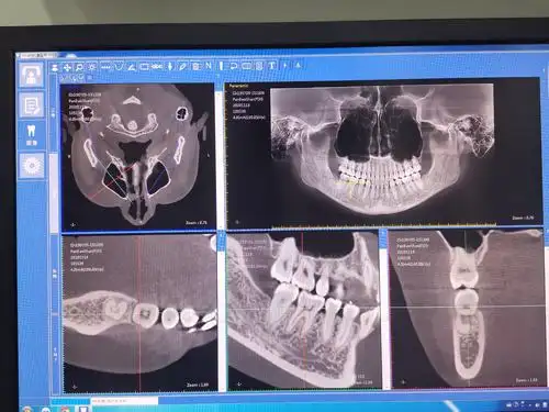 朗视大视野专业口腔cbct介绍