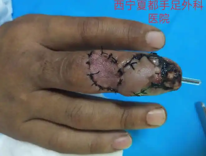 西宁夏都手足外科医院最近几例手指皮肤软组织缺损皮瓣修复