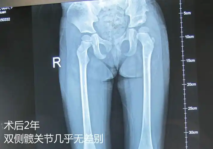 儿童发育性髋关节发育不良——易漏视但不容忽视的疾病