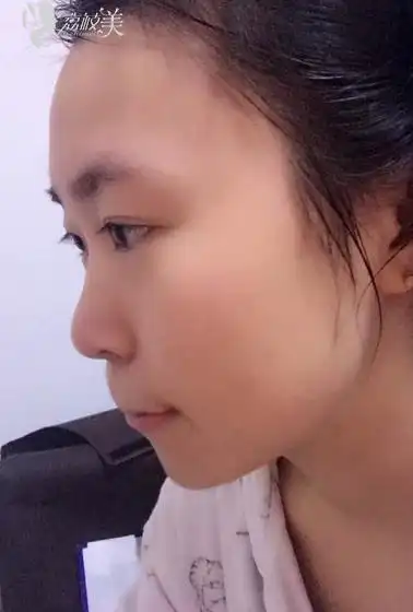 一起来看一下低鼻梁,圆鼻头,鼻翼宽大该怎么解决?