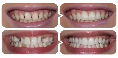 氧化锆全瓷牙价格表2021爱迪特二氧化锆全瓷牙多少钱