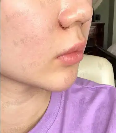 甩掉大鼻头鼻翼缩小前后对比图分享术后30天get精致美鼻