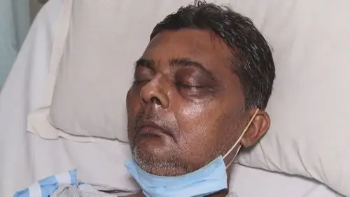 在印度一直与新冠疫情作斗争之际,该国出现了多种颜色的真菌感染病例