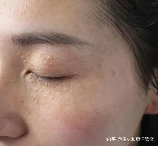 预防汗管瘤的七个生活细节