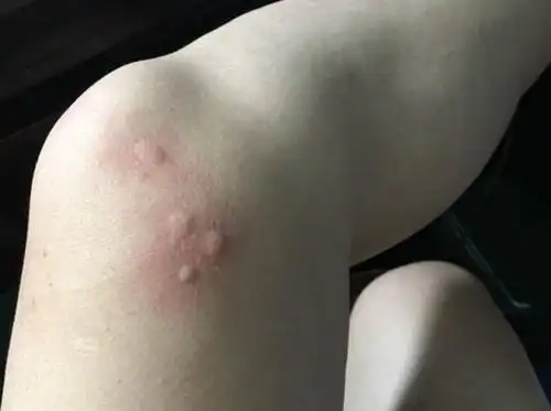 被蚊子叮咬后的人的皮肤