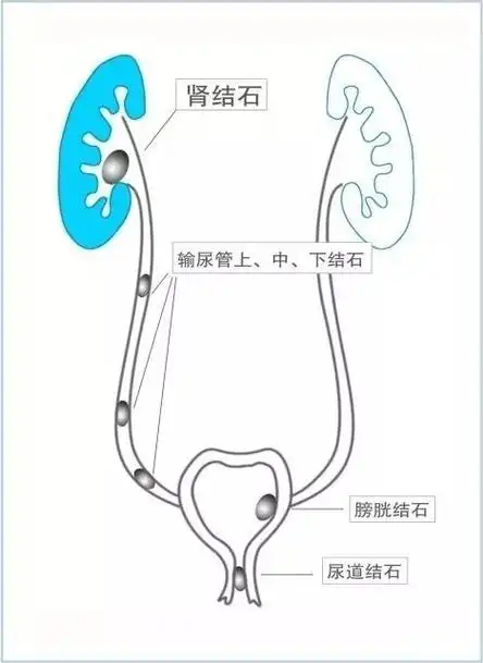 肾结石一般引起肾区疼痛常伴肋脊角(背部第12肋与脊柱的夹角)叩击痛
