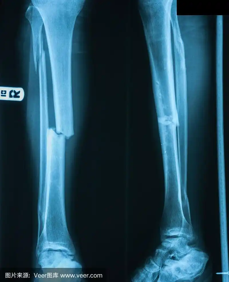 用木夹板固定的腿部骨折x线照片.