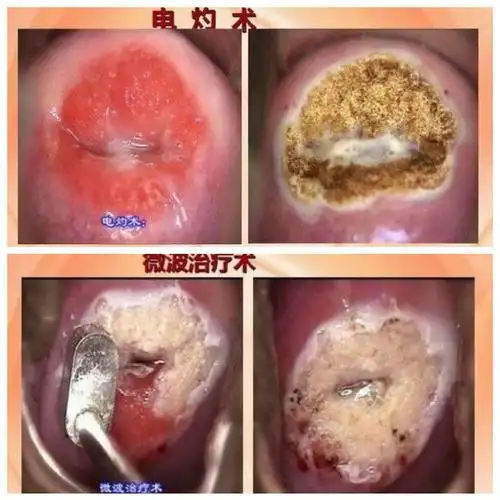 宫颈糜烂,你应该知道