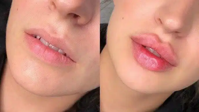 变美小心机玻尿酸丰唇