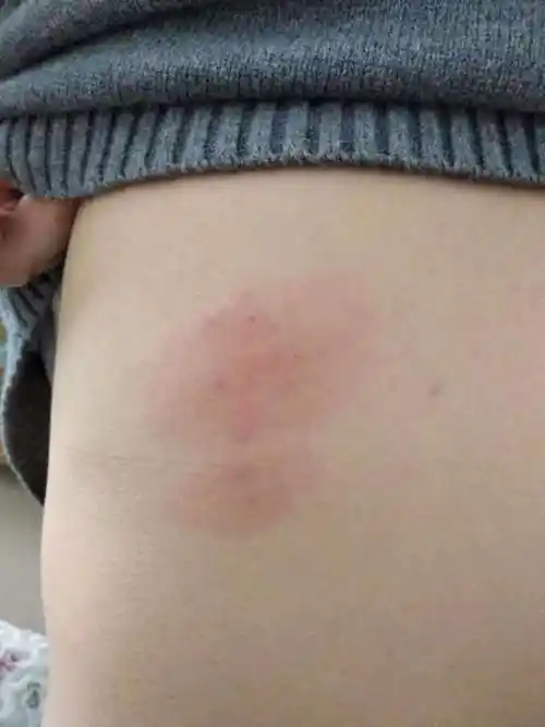 上周突然背后长了一片红斑开始很痒这两天仍然有些痒摸着明