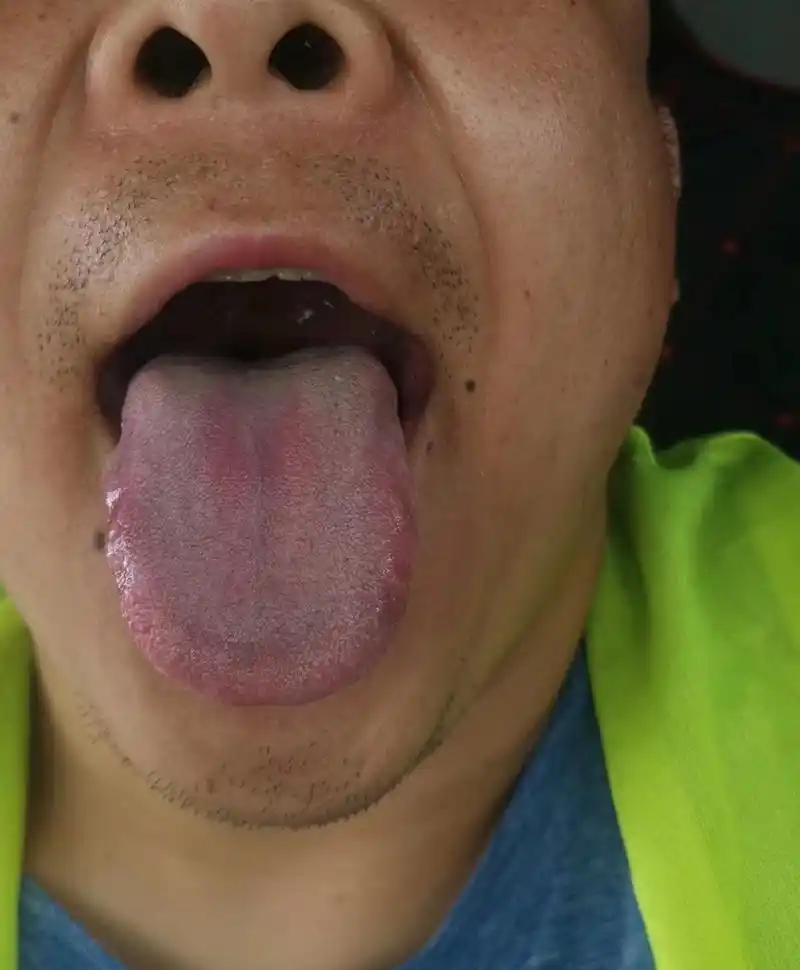 舌边鼓胀发红,肝气瘀滞,肝火旺盛,容易出现两肋胀痛,眼睛干涩,脾气