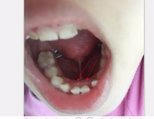 小孩换门牙, 从门牙后面长出两个白色突起, 如下图, 感觉像是新牙, 是