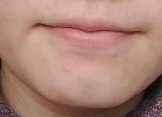 q4:下巴有坑代表什么