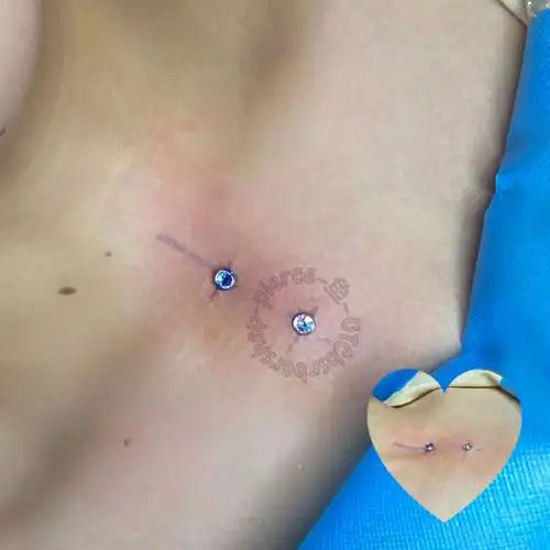 重庆穿刺-锁骨直角钉