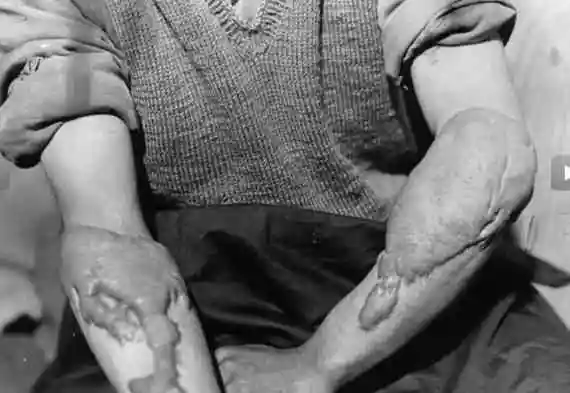 受到原子弹辐射的日本人受到原子弹辐射的日本人