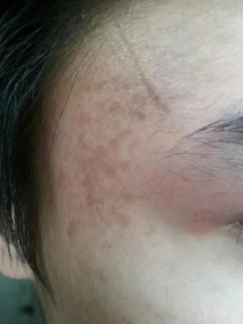 我男性 18 在右太阳穴长了斑,但不知道是什么斑,有些医生说是黄褐斑