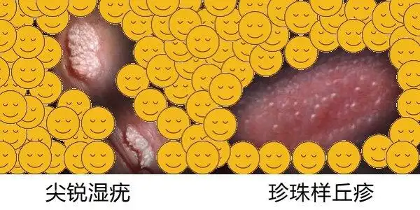 尖锐湿疣_介绍_症状表现_治疗方式 - 好大夫在线