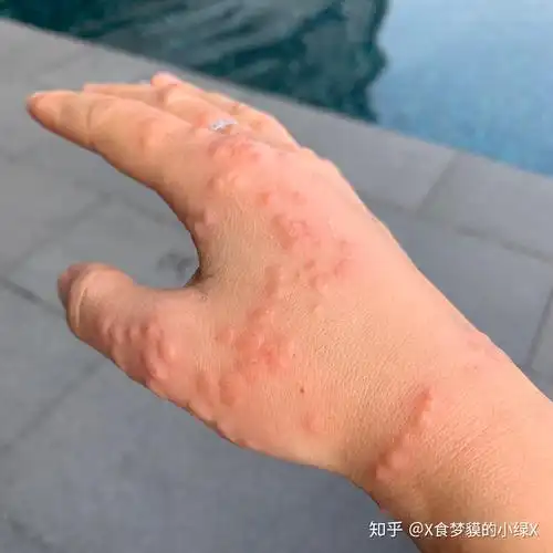 被水母蛰是一种什么体验? - 知乎