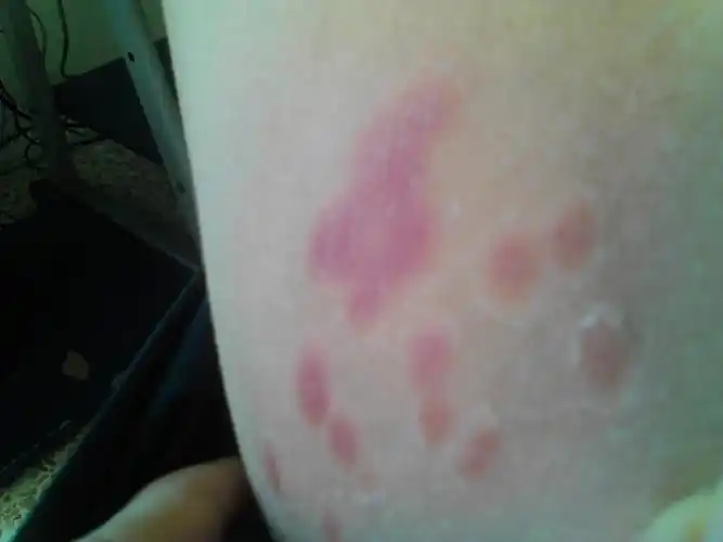 大腿内侧出现了红色斑块