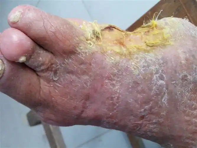 糖尿病严重下肢溃烂内服秘方