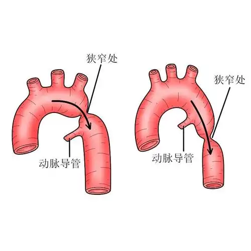 高血压多年来我院就诊,ct提示主动脉缩窄,最窄处胸主动脉直径只有9mm