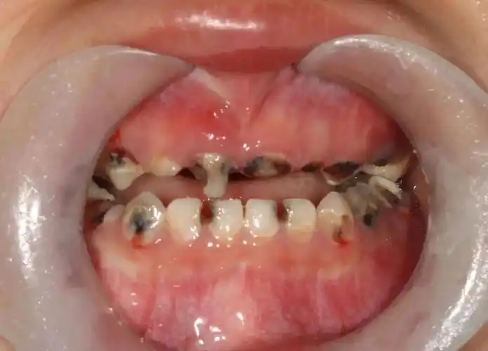 一颗烂牙引发骨髓炎四岁伢要刮骨疗毒