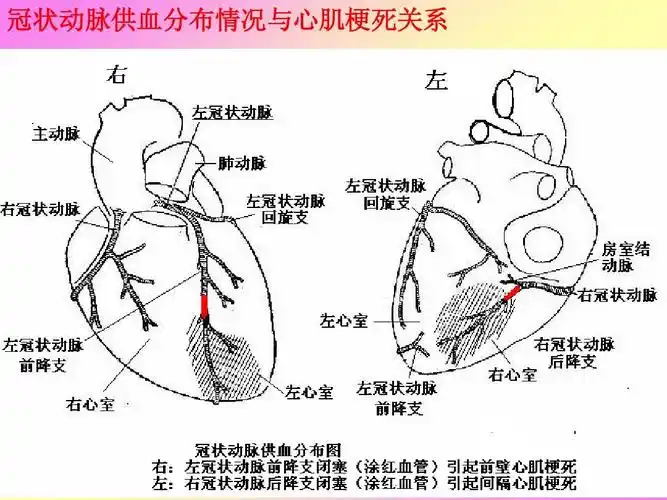 冠状动脉供血分布情况与心肌梗死关系