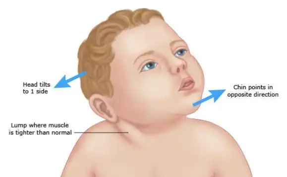 路医生说丨小孩脖子是歪的,严重么?该怎么办?