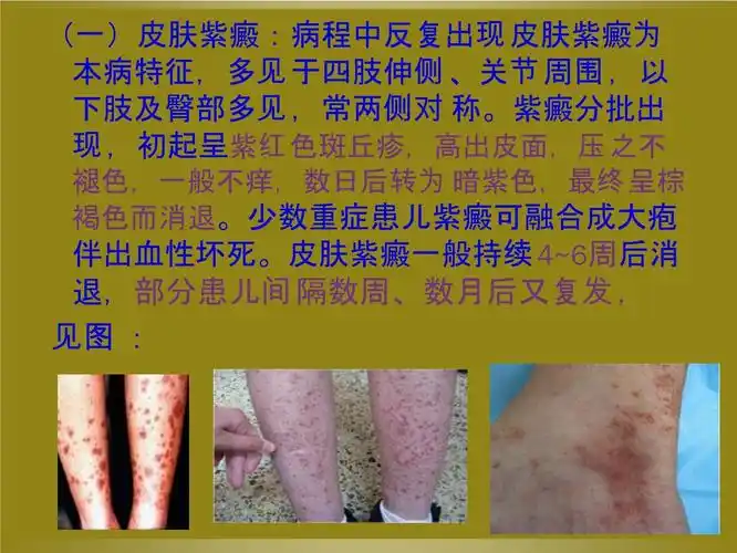 过敏性紫癜课件李芳红