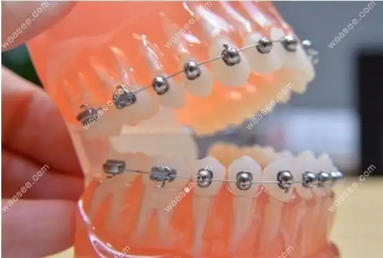 球形自锁托槽示意图