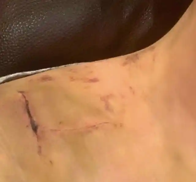 大嫂徐冬冬晒脂肪瘤术后照,伤口狰狞疤痕明显!