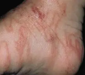 钩虫性十二指肠炎综合征