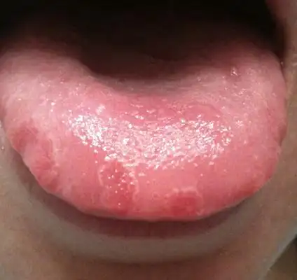 舌头发紫图片 (44)_有来医生