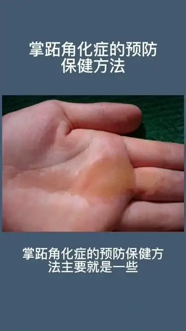 掌跖角化症的预防保健方法