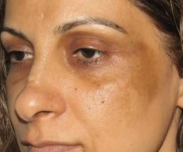 黑人女性面部长色斑图片