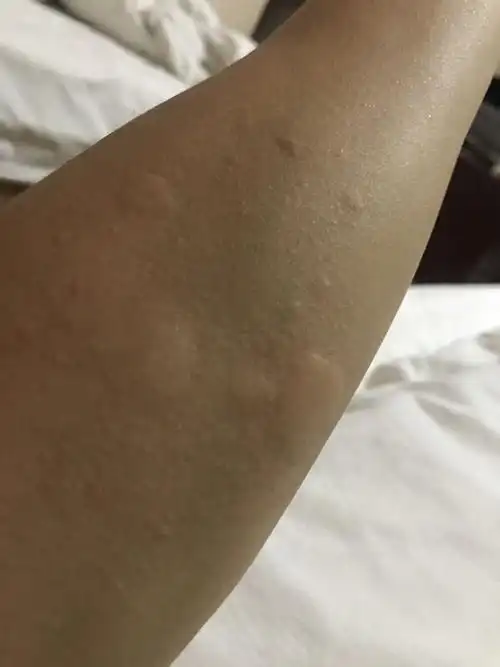 不知道怎么突然起来像蚊子咬下似的包,一片一片的,但是睡醒之后就没事